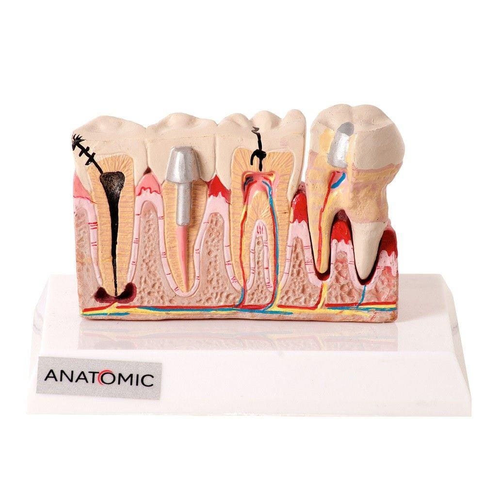 Patologia Dentária e Placa Explicativa em 2 Partes Modelo Anatômico