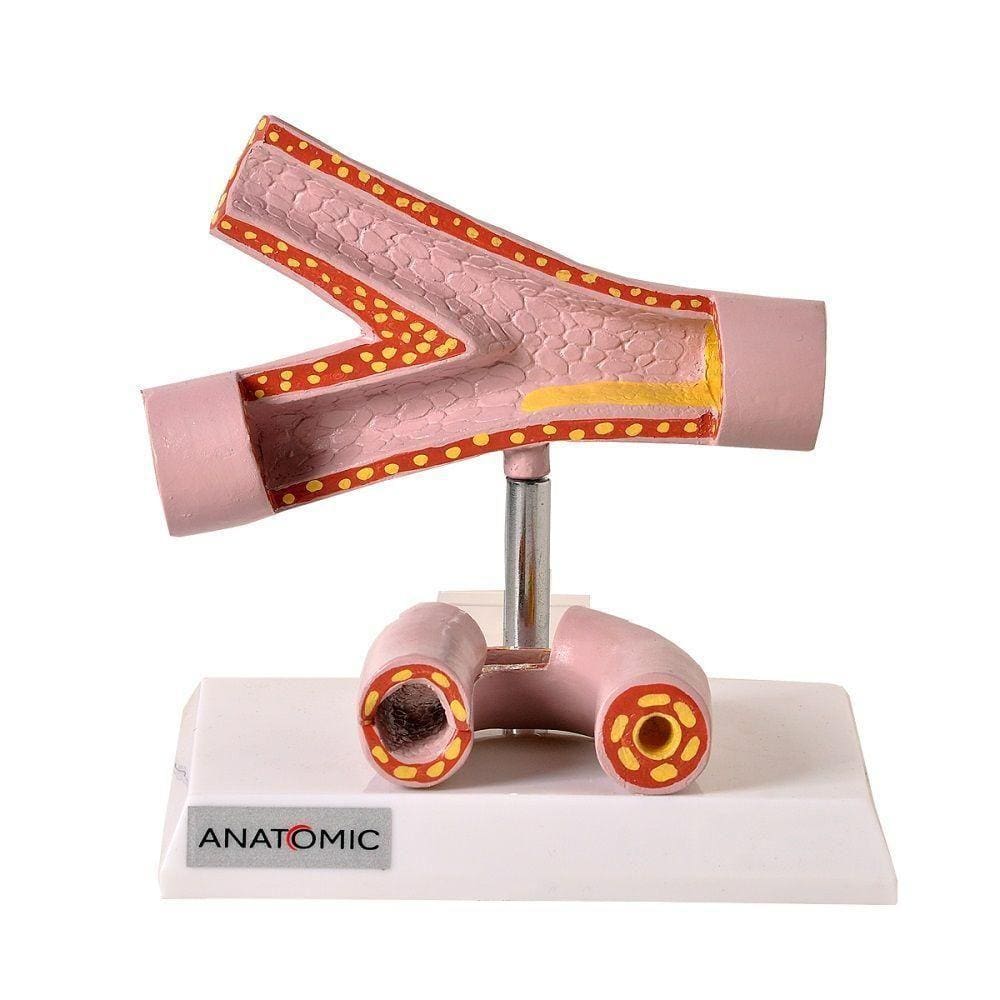 Artéria Saudável e Patológica Anatomia Anatomic