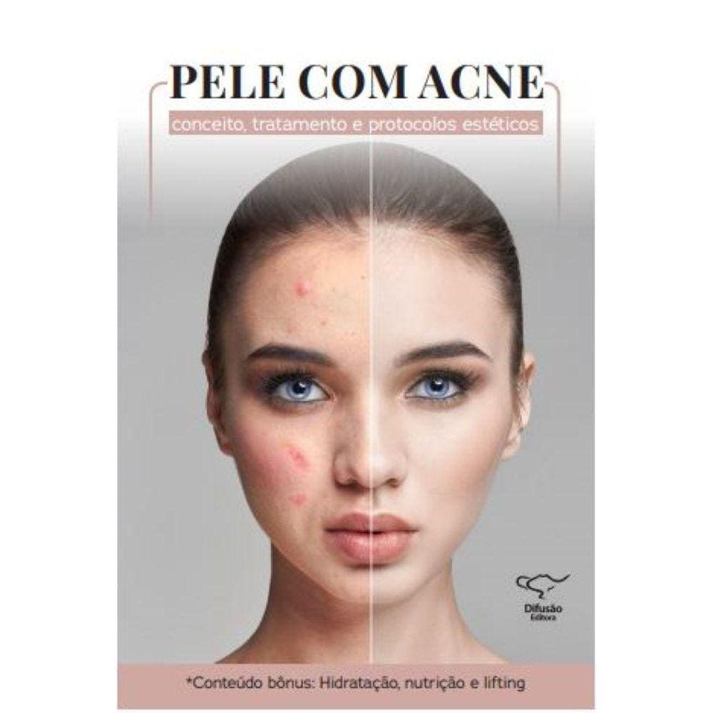 Pele com acne: conceito, tratamento e protocolos estéticos - Conceito, tratamento e protocolos estéticos