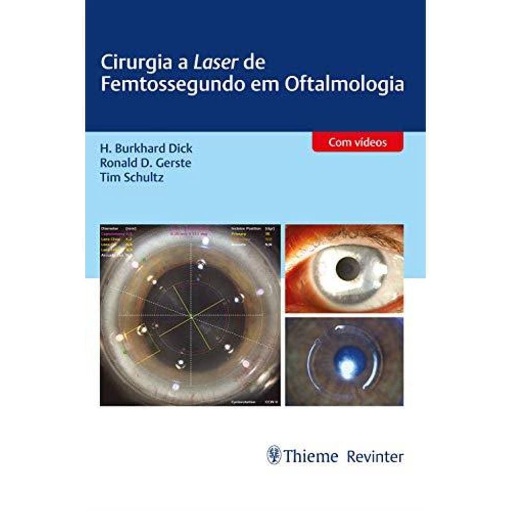 Cirurgia A Laser De Femtossegundo Em Oftalmologia Com Video
