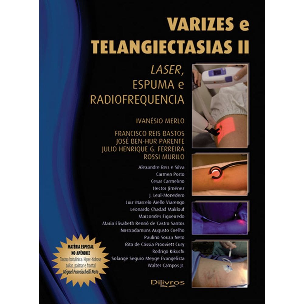 Varizes E Telangiectasias Ii Laser Espuma E Radiofrequencia