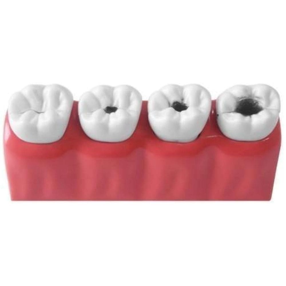 Macro Modelo Anatômico Odontológico Evolução Da Cárie